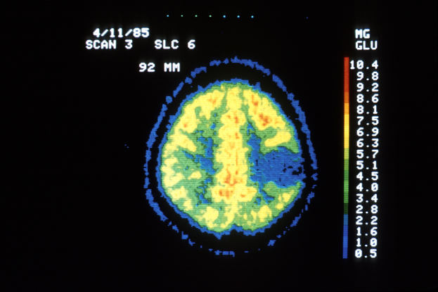 StrokeCap - Die mobile Schlaganfall-Diagnostik der Zukunft